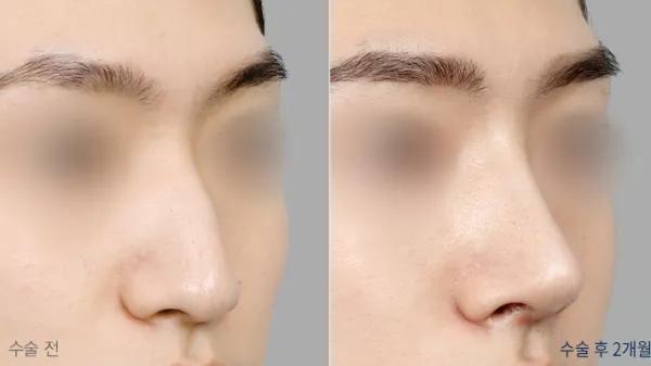 Before/After