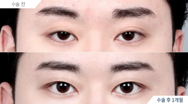 Before/After