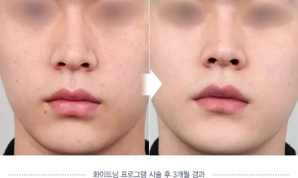 Before/After