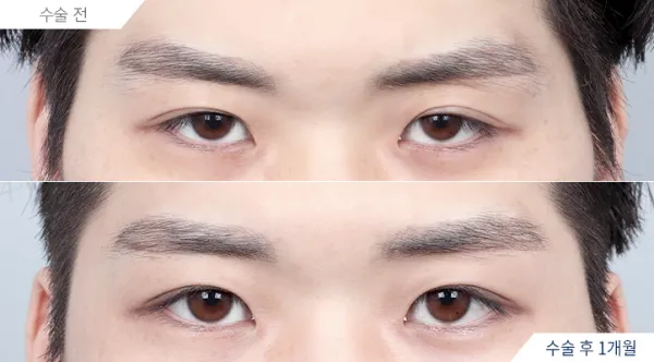 Before/After