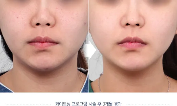 Before/After