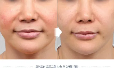 Before & After