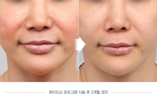 Before/After