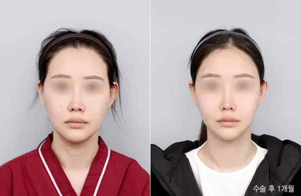 Before/After