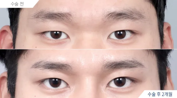 Before/After