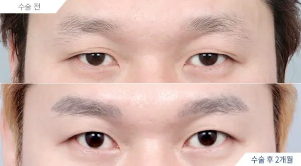 Before/After