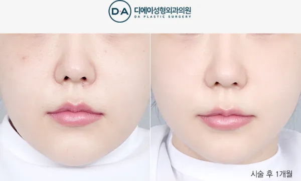 Before/After