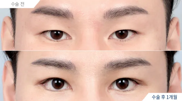 Before/After