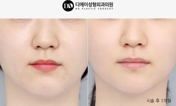 Before/After