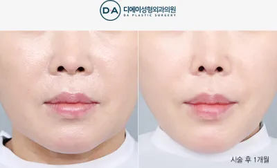 Before & After