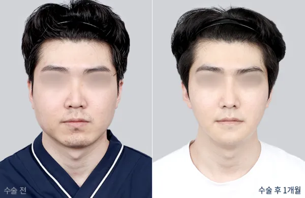 Before/After
