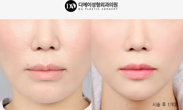 Before/After