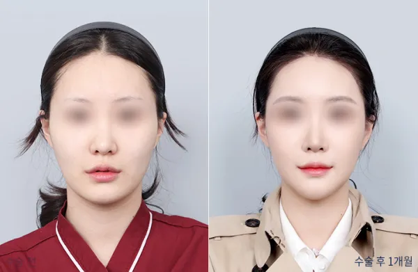 Before/After