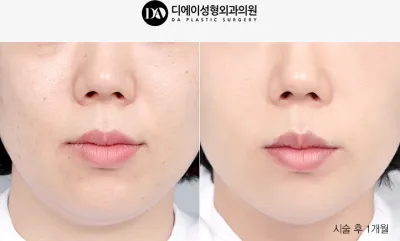 Before & After