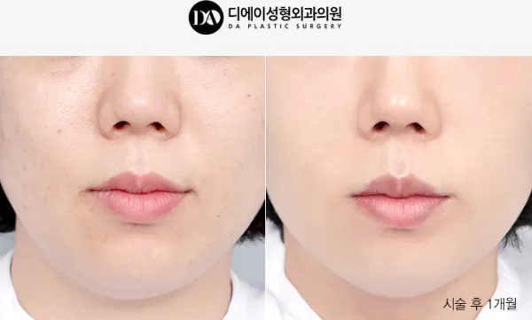 Before/After