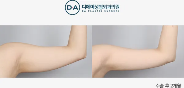 Before/After