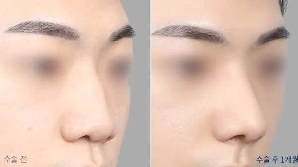 Before/After