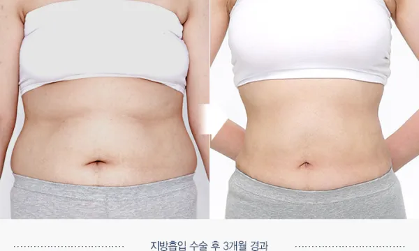 Before/After