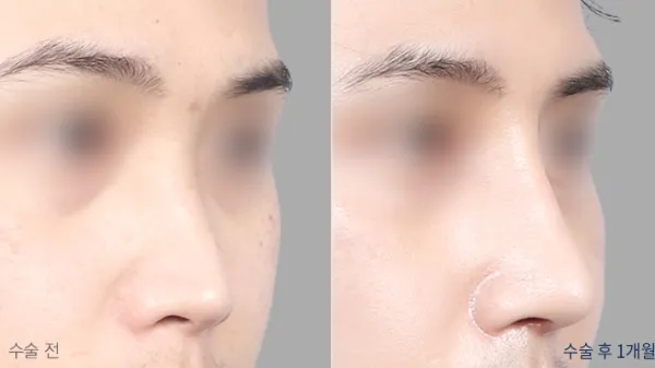 Before/After