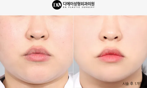 Before/After