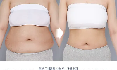 Before & After