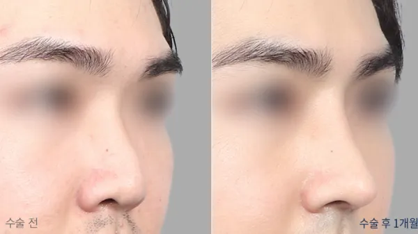Before/After