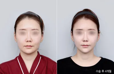 Before & After
