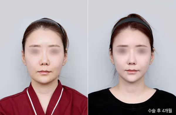 Before/After