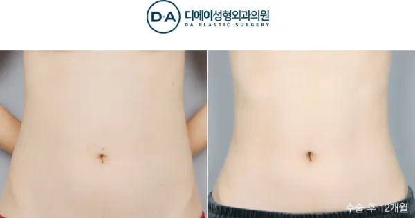 Before/After