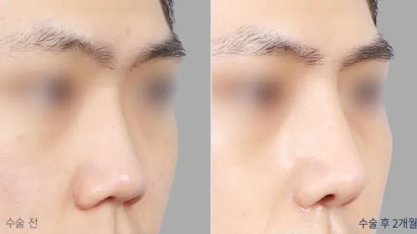 Before/After