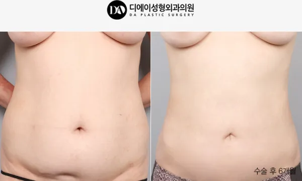 Before/After