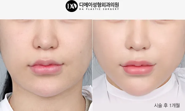 Before/After
