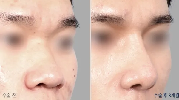 Before/After