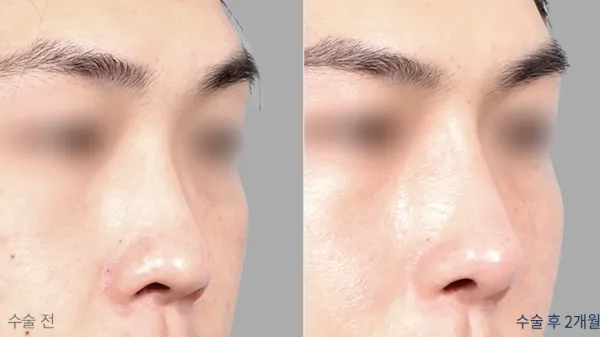 Before/After