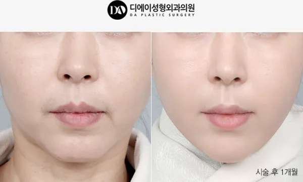 Before/After