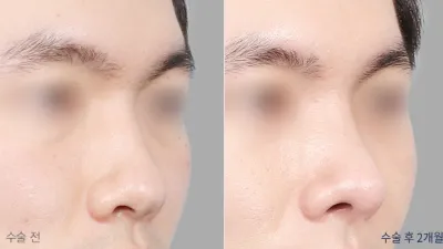 Before & After