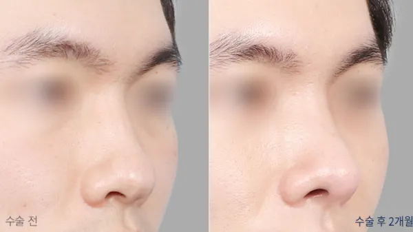 Before/After