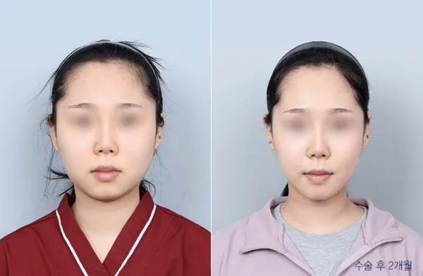 Before/After