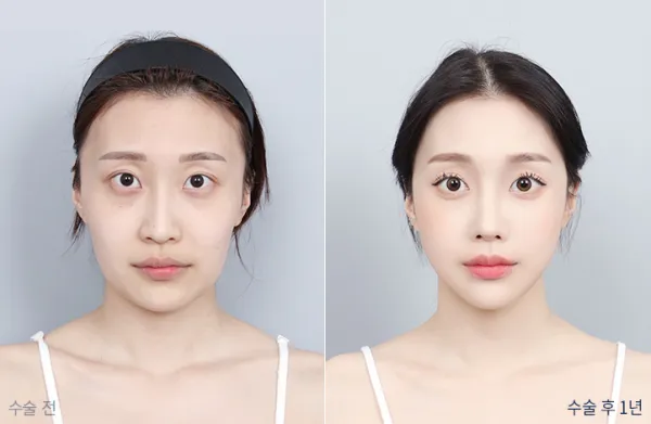 Before/After