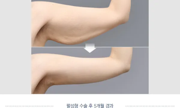 Before/After