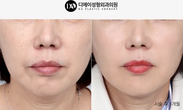 Before/After