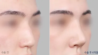 Before & After