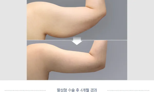 Before/After
