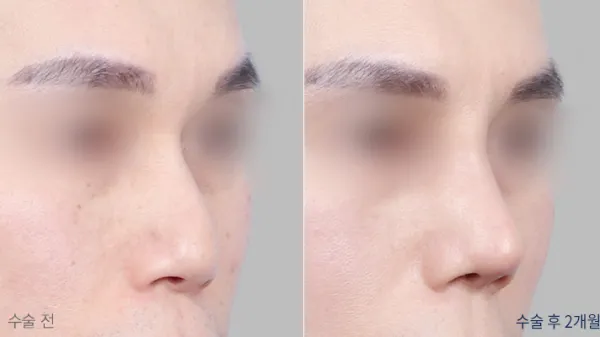 Before/After