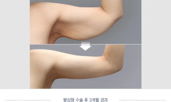 Before/After
