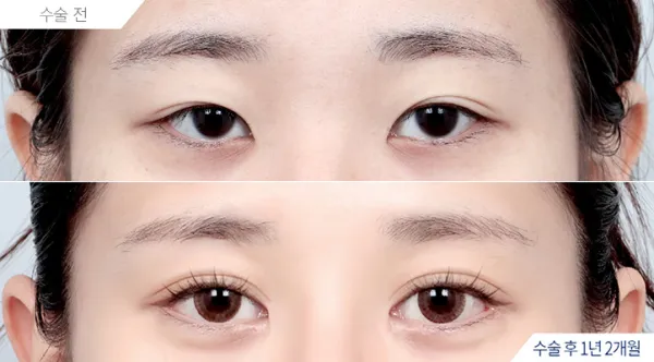 Before/After