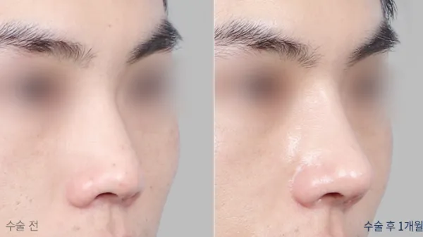 Before/After