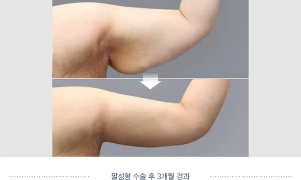 Before/After