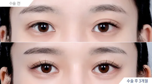 Before/After