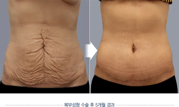 Before/After